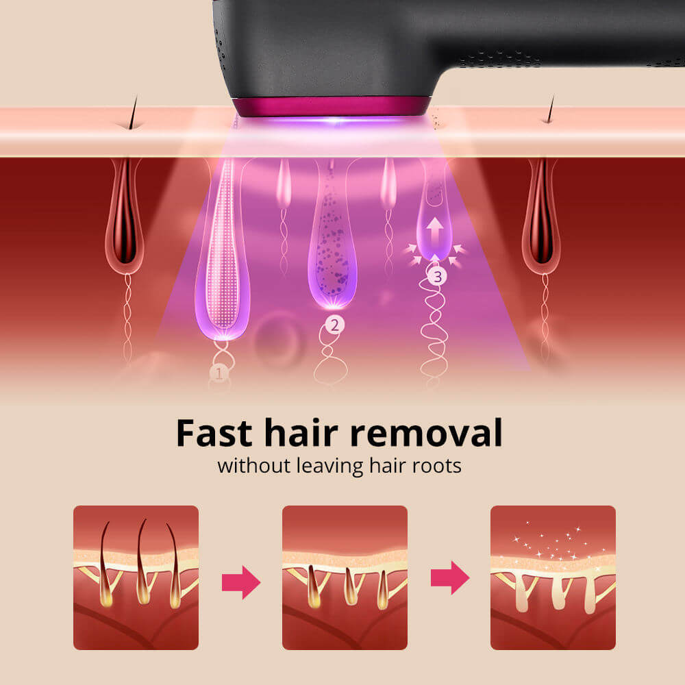 IPL laser hair removal device demonstrating fast hair removal process without leaving hair roots.