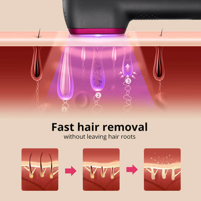 IPL laser hair removal device demonstrating fast hair removal process without leaving hair roots.